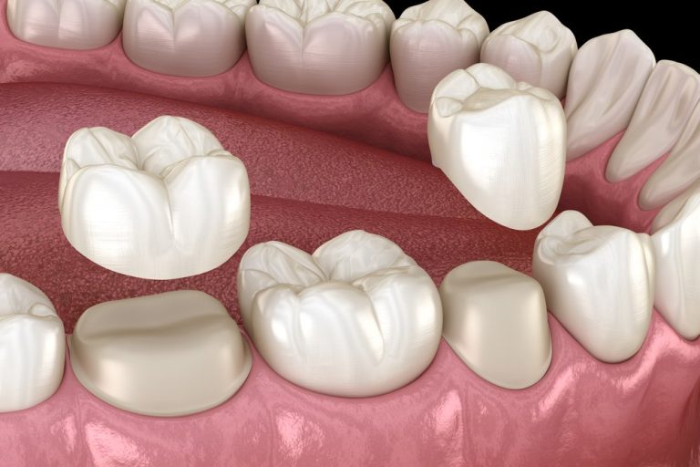 Zirconia Crown Treatment at dental surgeons Lahore Pakistan