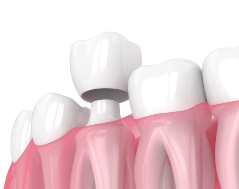 Zirconia Crown Treatment at dental surgeons Lahore Pakistan