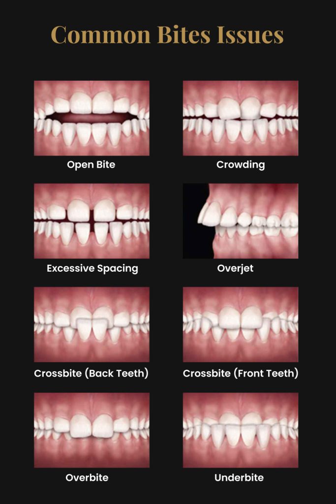 Common Bits Issues treatment at Dental Surgeons - The best Dental Clinic Lahore