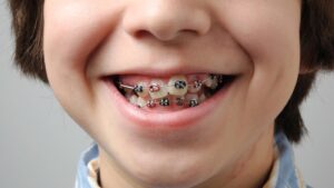 Braces for Kids