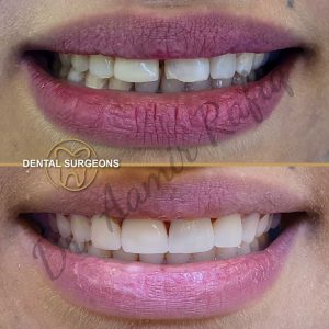 Discover the Best Dentist in Lahore: Dr. Aamir Rafiq at Dental Surgeons Clinic Tooth reshaping and gap closure with ceramic bonding