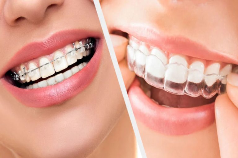 Braces vs Aligners: What’s Best for Your Smile? by Dr. Aamir Rafiq Braces Vs Aligners