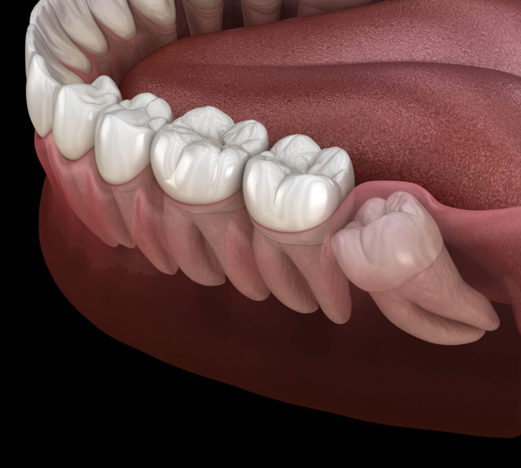 7 Signs You May Need Wisdom Teeth Removal